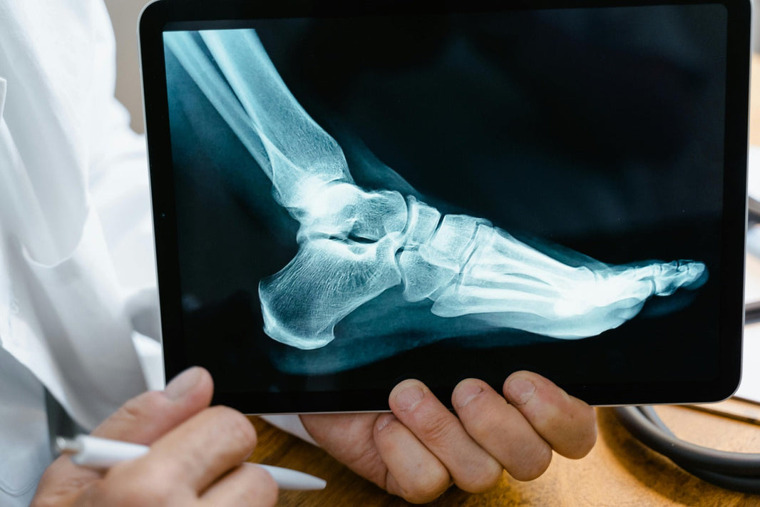 Vitamin K2 forPost-Surgical Bone Healing